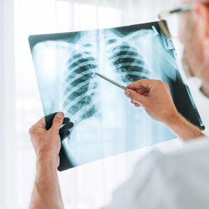 Doctor examining an x-ray showing the bones of the rib cage