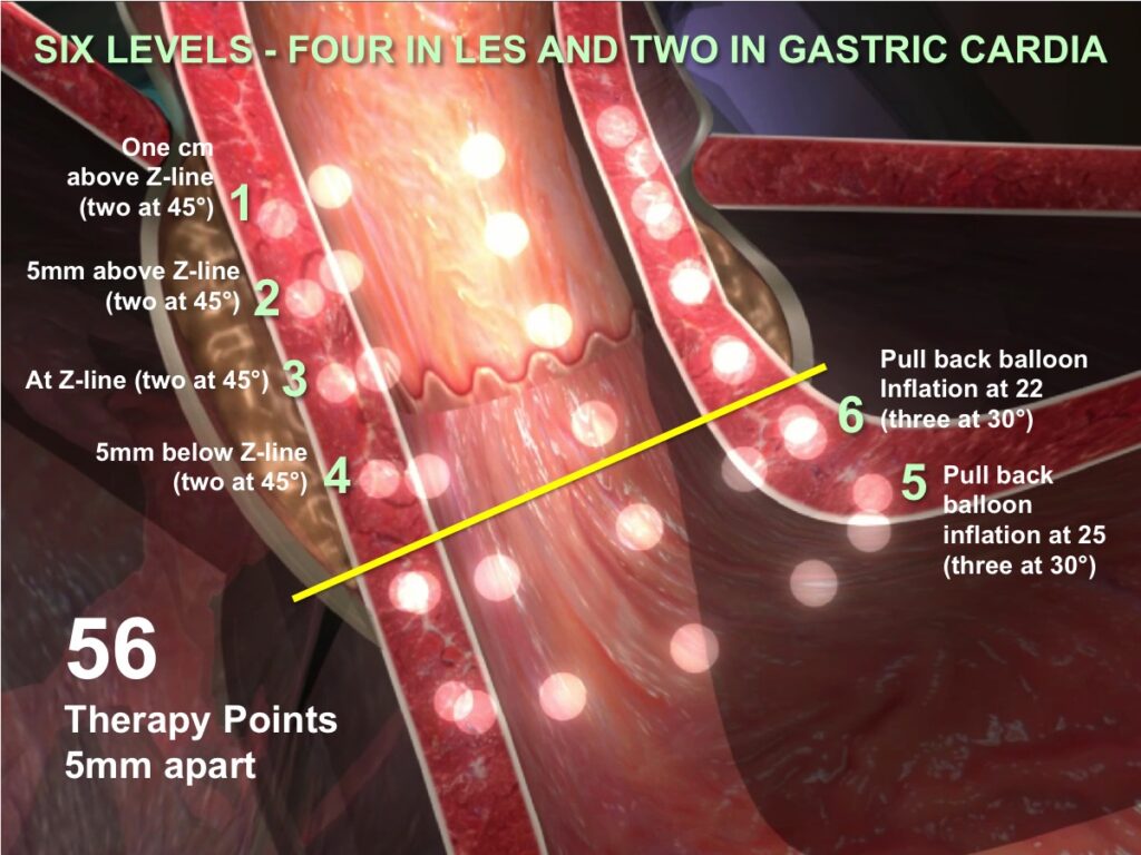 Illustration of the 6 Levels - Four in les and two in gastric cardia