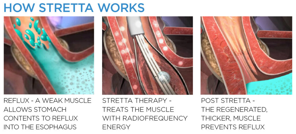 Infographic of How Stretta Works: Refulx, Stretta Therapy, Post Stretta