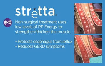 Illustration of stretta Non-surgical treatment uses low levels of RF Energy to strengthen/thicken the muscle. • Protects esophagus from reflux • Reduces GERD symptoms